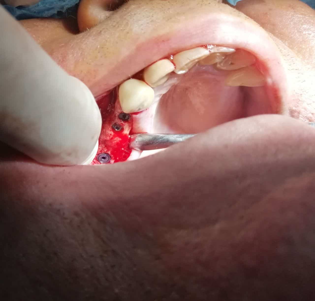 Implant Bredent - Caz 4